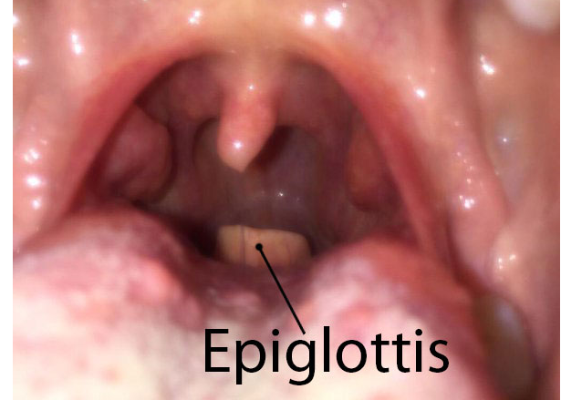 Inflammation of the Epiglottis