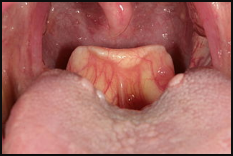 swollen epiglottis home remedy - high rising epiglottis