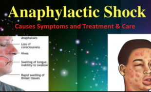 Anaphylaxis-Anaphylactic Shock symptoms treatment