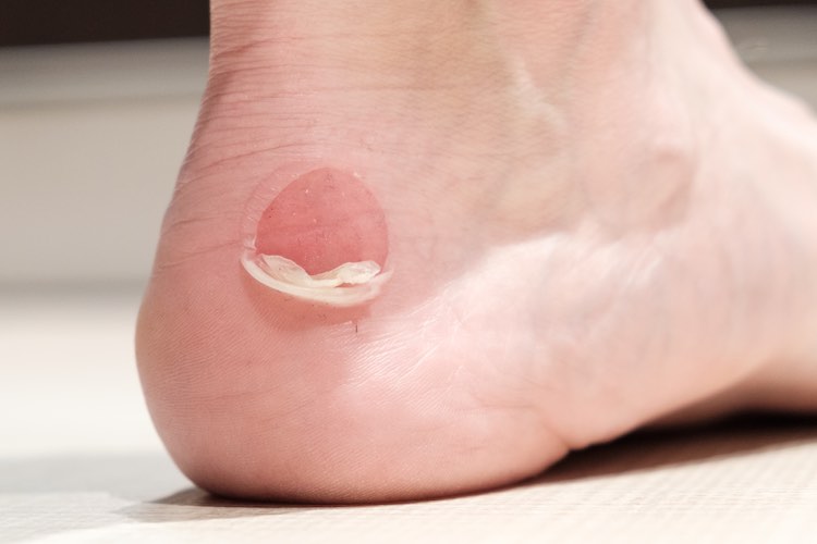 foot blisters - common foot problems