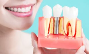dental implants treatment