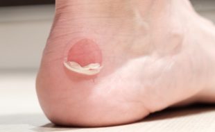 foot blisters - common foot problems